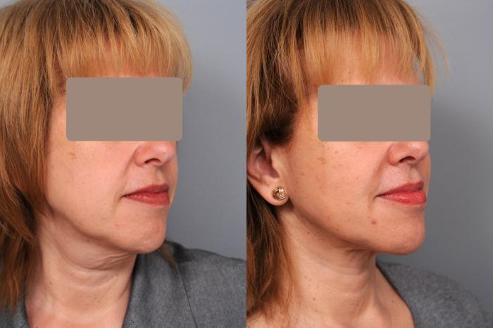 Before & After Neck Liposuction / Chin Liposuction  Case 52 View #2 View in New York, NY