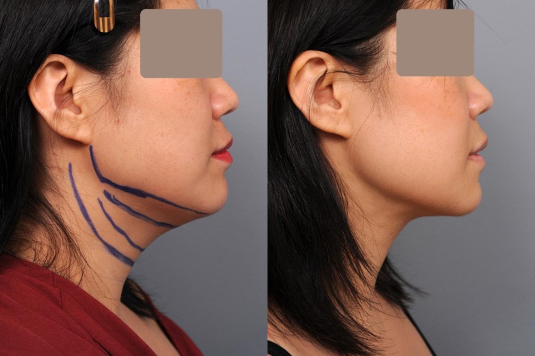 Neck Liposuction / Chin Liposuction Before and After Photo Gallery ...