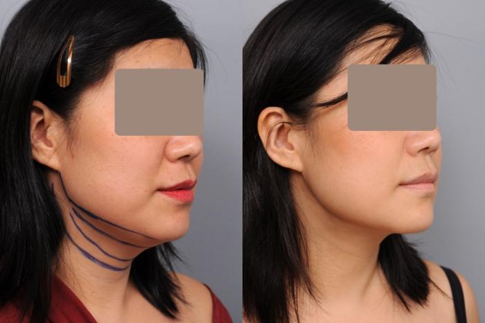 Before & After Neck Liposuction / Chin Liposuction  Case 54 View #2 View in New York, NY