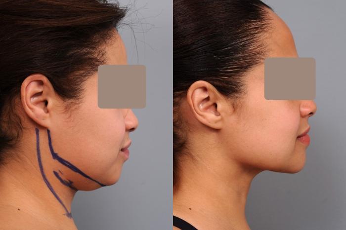 Before & After Neck Liposuction / Chin Liposuction  Case 55 View #1 View in New York, NY
