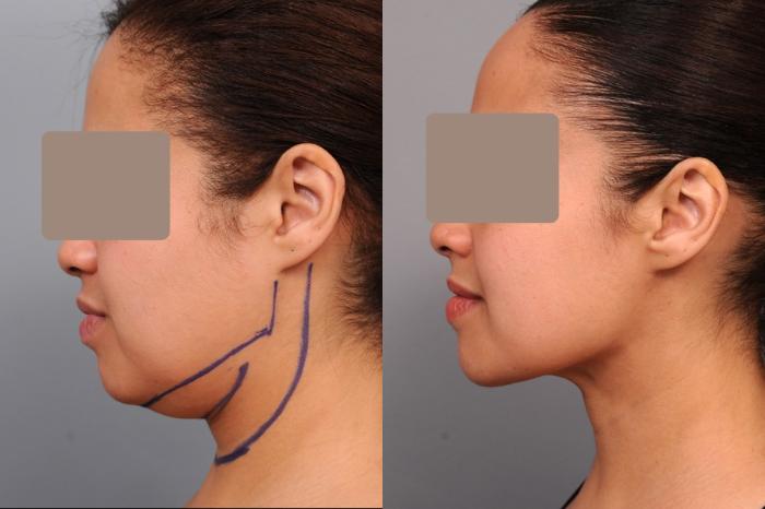 Before & After Neck Liposuction / Chin Liposuction  Case 55 View #3 View in New York, NY