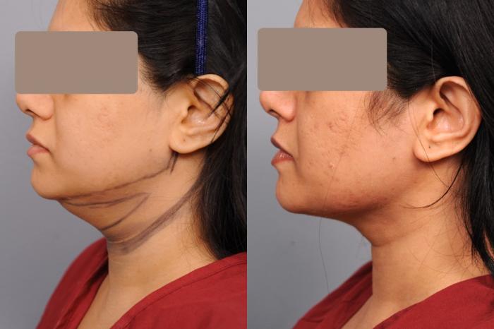 Before & After Neck Liposuction / Chin Liposuction  Case 57 View #1 View in New York, NY