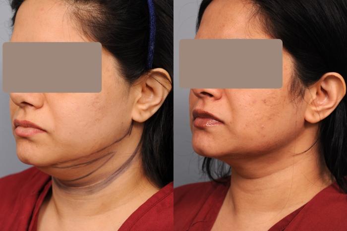 Before & After Neck Liposuction / Chin Liposuction  Case 57 View #2 View in New York, NY
