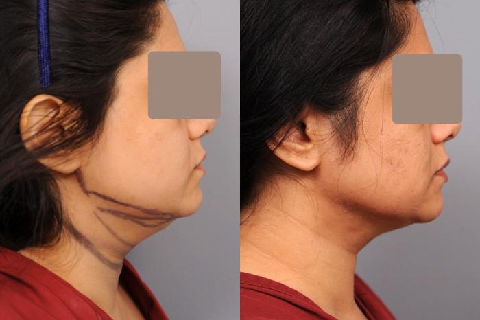 Before & After Neck Liposuction / Chin Liposuction  Case 57 View #3 View in New York, NY