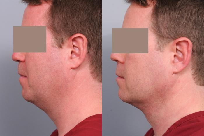 Before & After Neck Liposuction for Men Case 53 View #1 View in New York, NY