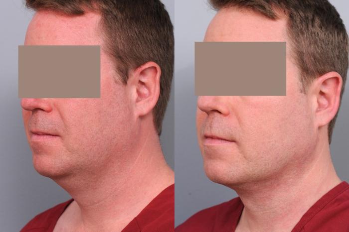 Before & After Neck Liposuction for Men Case 53 View #2 View in New York, NY