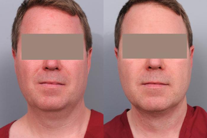 Before & After Neck Liposuction for Men Case 53 View #3 View in New York, NY