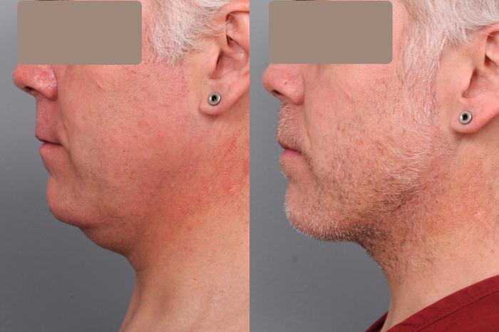 Before & After Neck Liposuction for Men Case 58 View #1 View in New York, NY