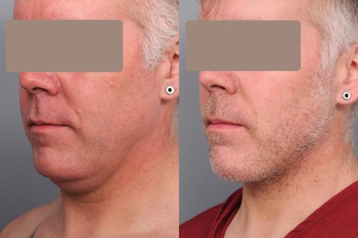 Before & After Neck Liposuction for Men Case 58 View #2 View in New York, NY