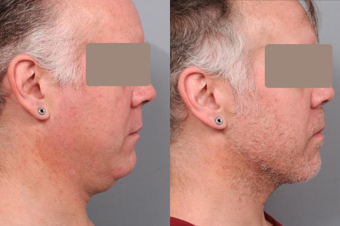 Before & After Neck Liposuction for Men Case 58 View #3 View in New York, NY