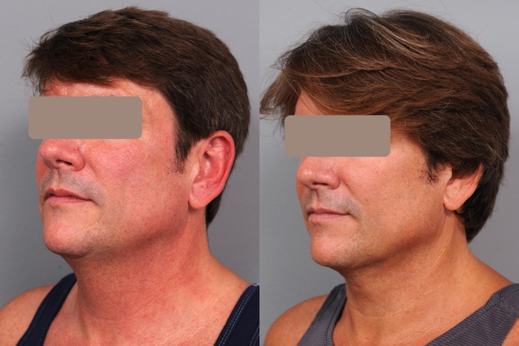 Before & After Neck Liposuction / Chin Liposuction  Case 59 View #1 View in New York, NY