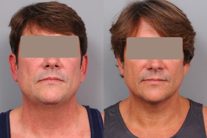 Before & After Neck Liposuction for Men Case 59 View #2 View in New York, NY