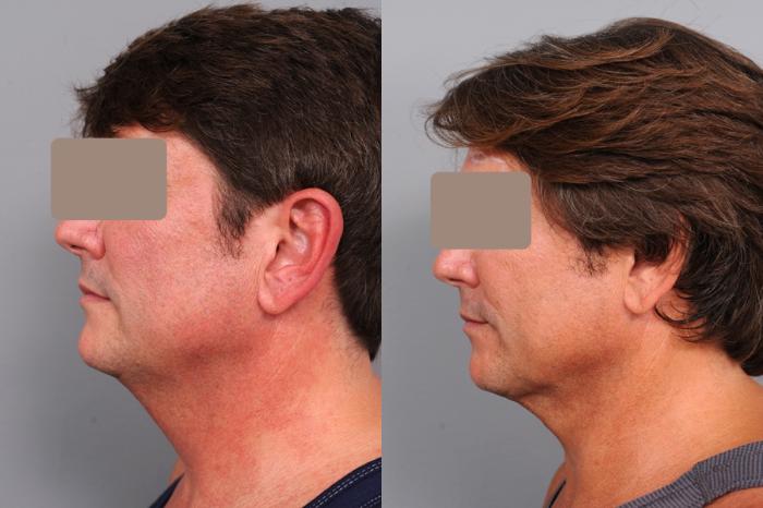 Before & After Neck Liposuction for Men Case 59 View #3 View in New York, NY