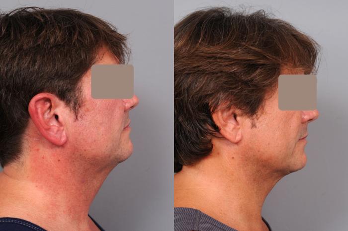 Before & After Neck Liposuction for Men Case 59 View #4 View in New York, NY