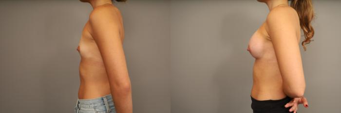 Before & After Over the Muscle Breast Augmentation  Case 332 Left Side View in New York, NY