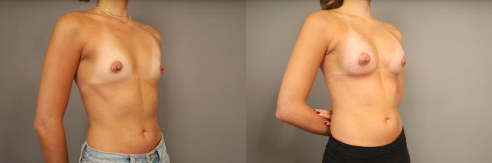 Before & After Over the Muscle Breast Augmentation  Case 332 Left three quarter view  View in New York, NY