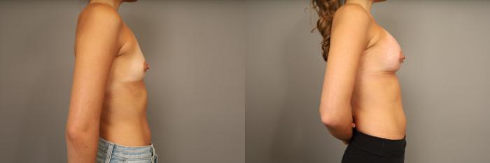 Before & After Over the Muscle Breast Augmentation  Case 332 Right Side View in New York, NY