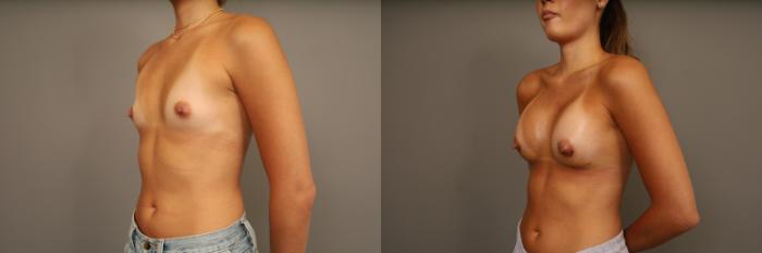 Before & After Over the Muscle Breast Augmentation  Case 332 Right Three Quarter View  View in New York, NY