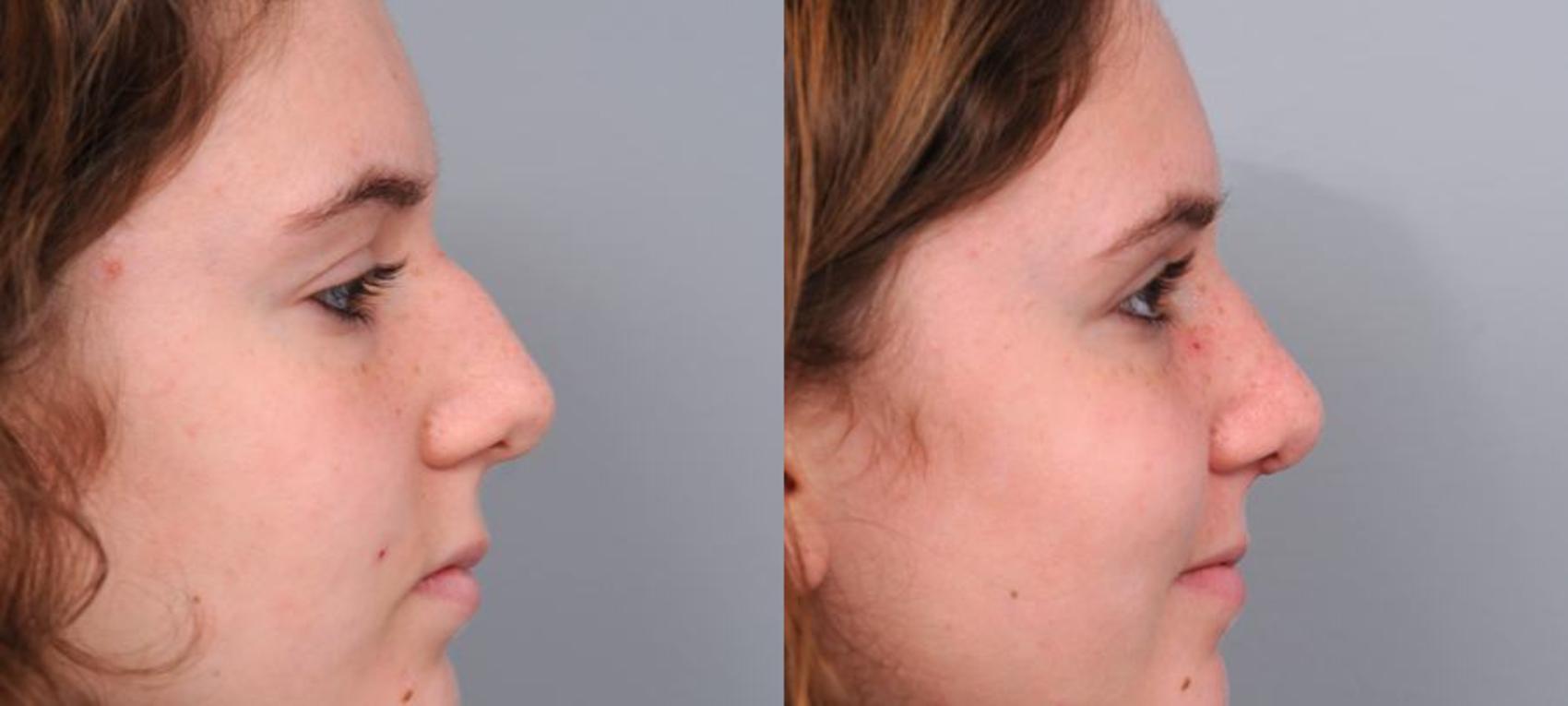 Before & After Rhinoplasty Case 60 View #1 View in New York, NY