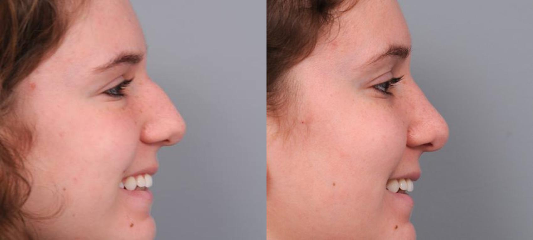 Rhinoplasty in New York City - Dr. Thomas Sterry