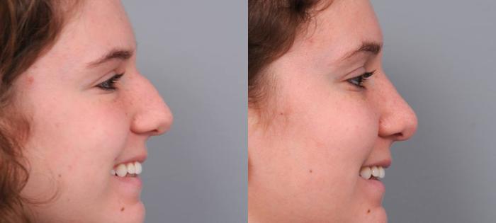 Before & After Rhinoplasty Case 60 View #2 View in New York, NY