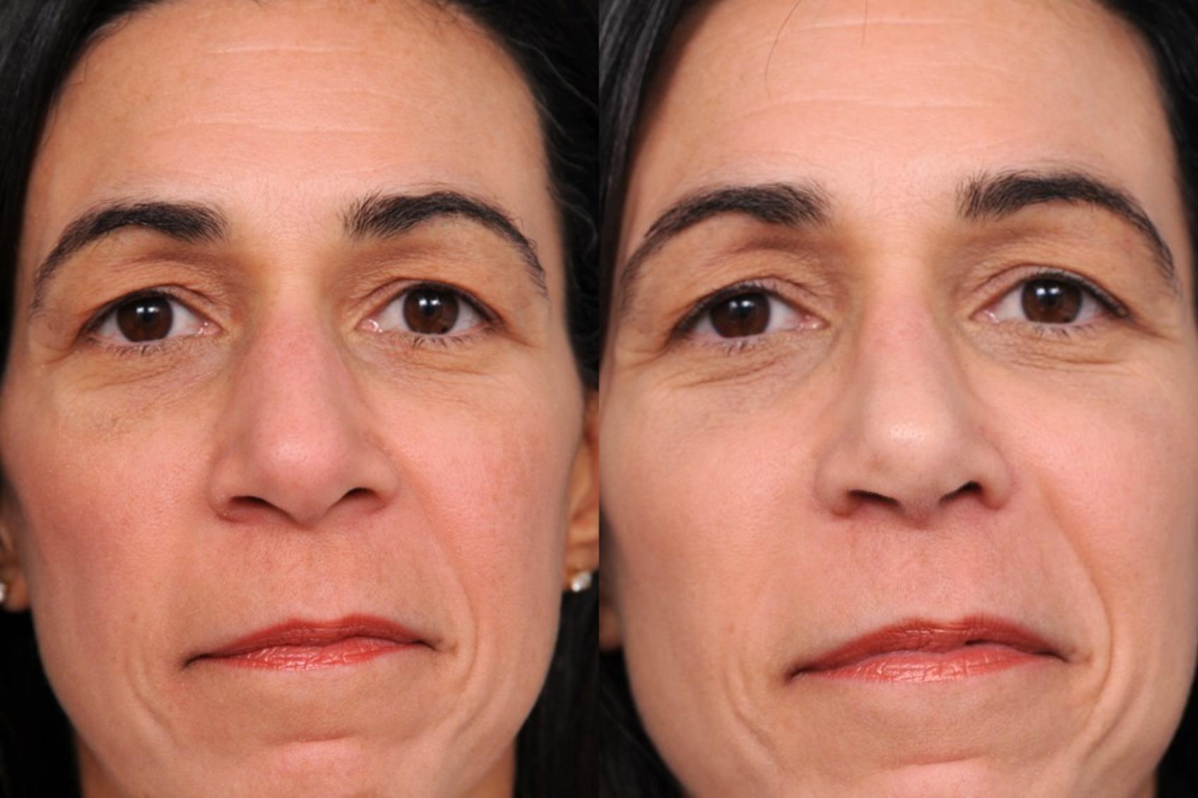 Before & After Rhinoplasty Case 61 View #1 View in New York, NY