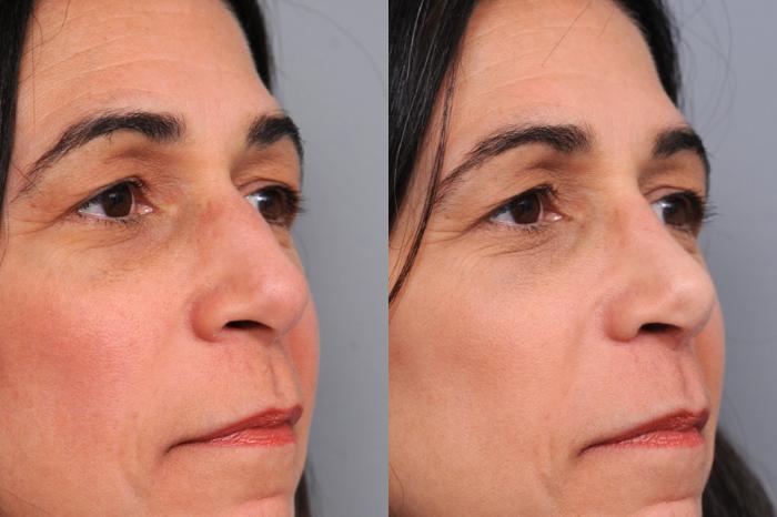 Before & After Rhinoplasty Case 61 View #2 View in New York, NY