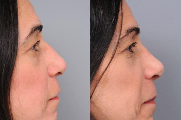 Before & After Rhinoplasty Case 61 View #3 View in New York, NY