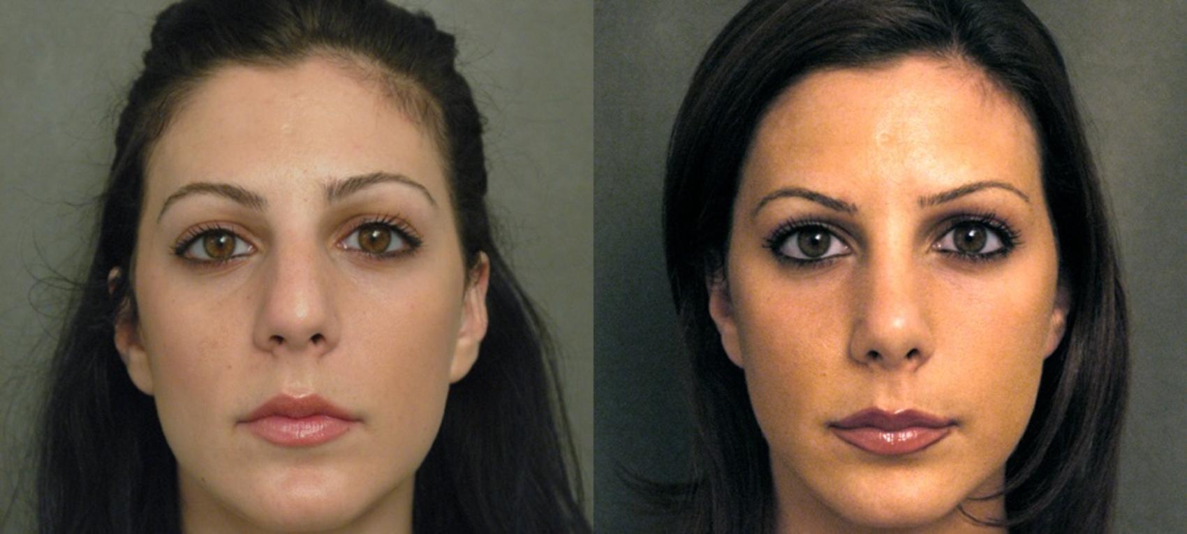 Before & After Rhinoplasty Case 62 View #1 View in New York, NY