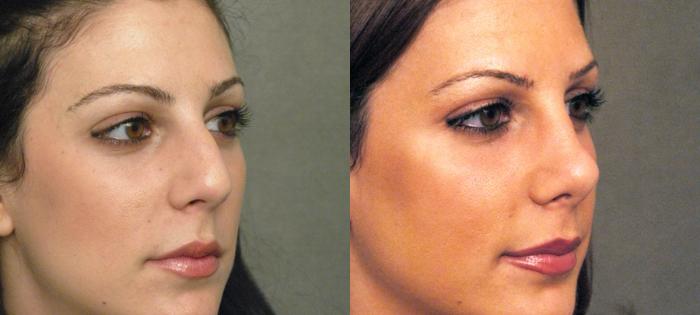Before & After Rhinoplasty Case 62 View #2 View in New York, NY