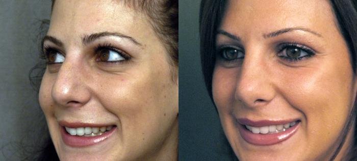 Before & After Rhinoplasty Case 62 View #3 View in New York, NY