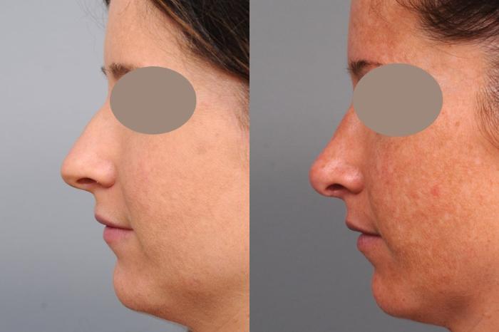 Before & After Rhinoplasty Case 63 View #2 View in New York, NY