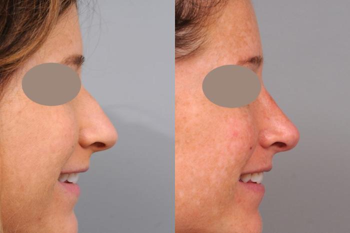Before & After Rhinoplasty Case 63 View #3 View in New York, NY