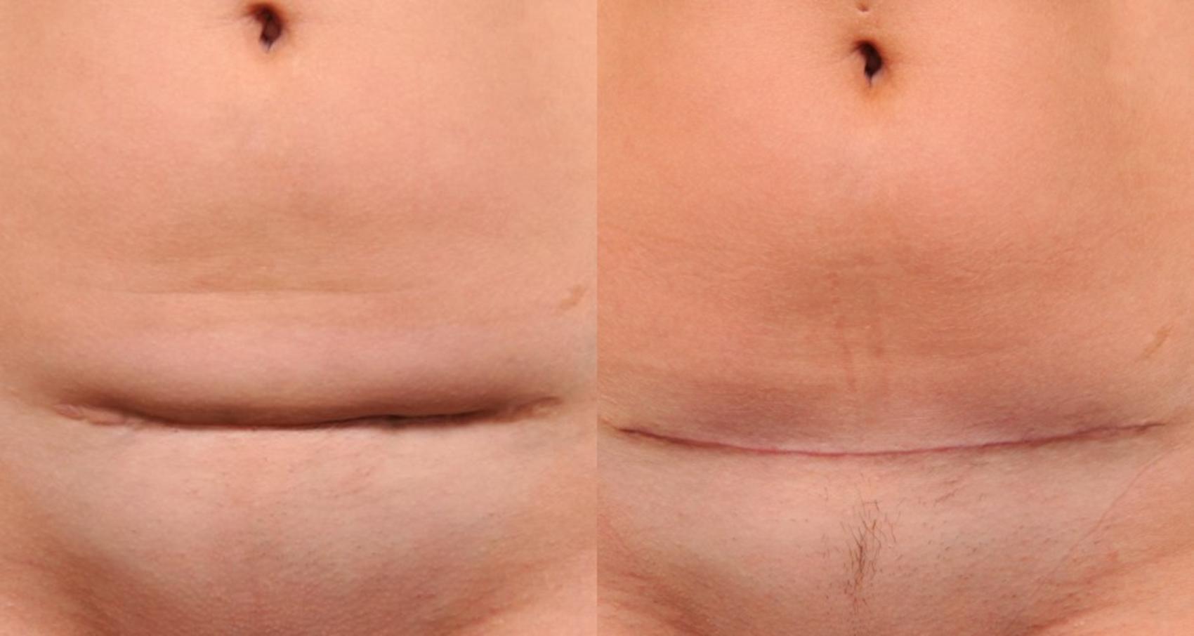 Before & After Scar Revision Case 118 View #2 View in New York, NY