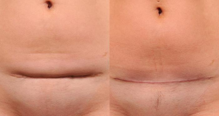 C-Section Scar Removal Case #171