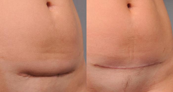C-Section Scar Removal New York City