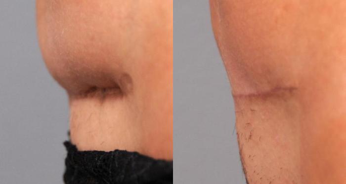 C-section Scar Removal Procedures - Royal Centre of Plastic Surgery