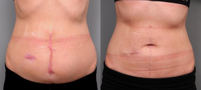 Tummy Tuck Revision Archives