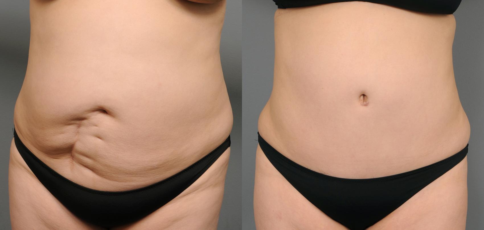 Tummy Scar Removal In New York City