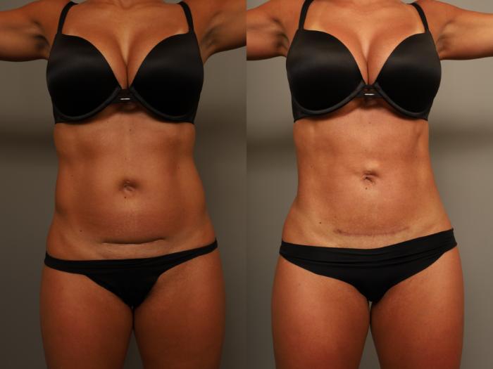 Before & After Scar Revision Case 304 Front View in New York, NY