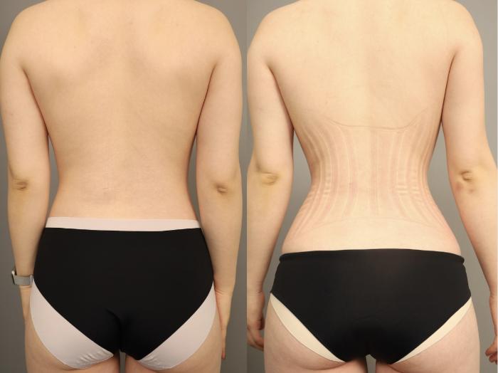 Before & After Scarless Rib Contouring (RibXcar)  Case 330 Back View in New York, NY