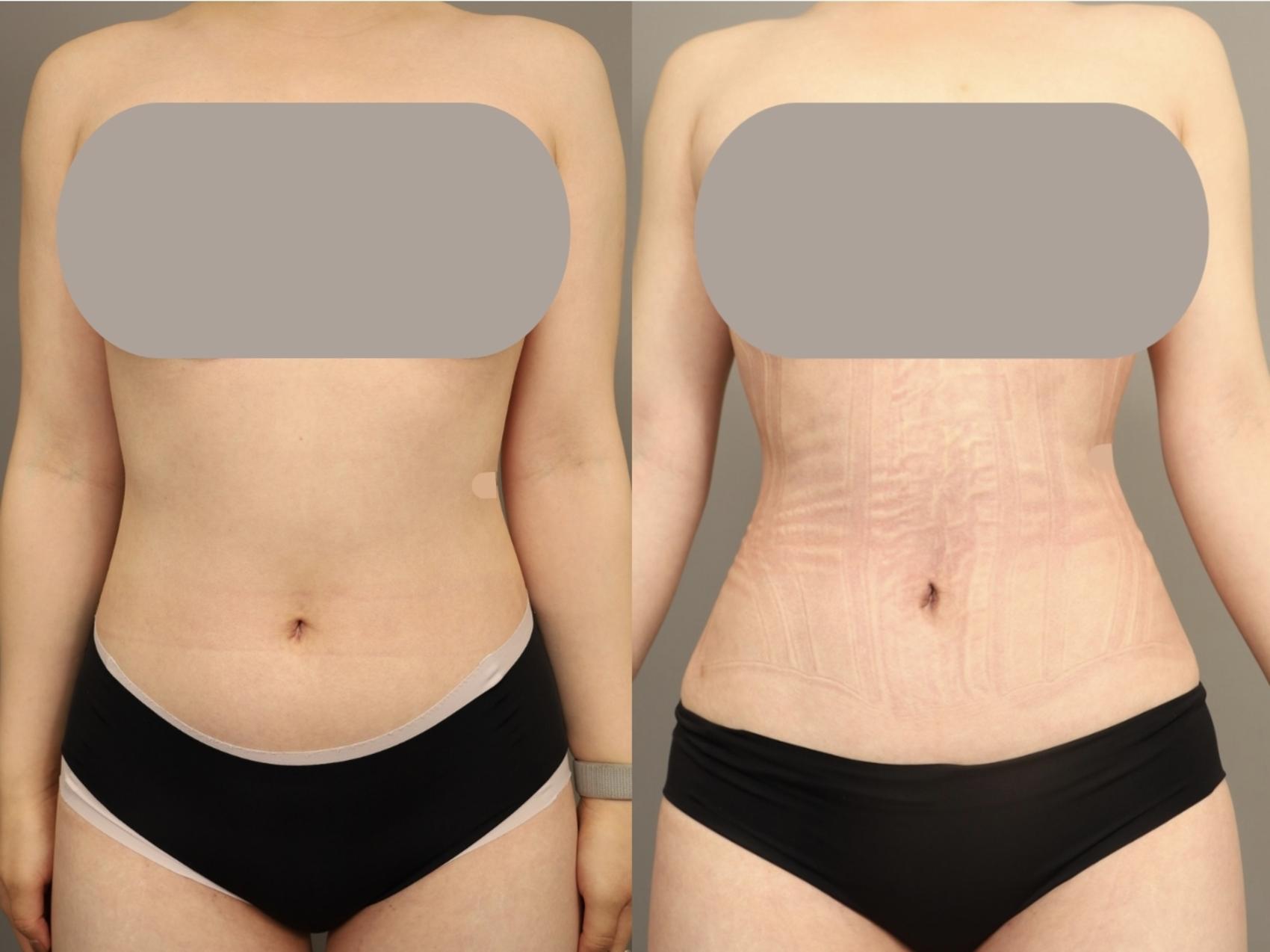 Before & After Scarless Rib Contouring (RibXcar)  Case 330 Front View in New York, NY