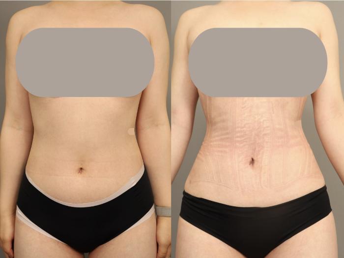 Before & After Scarless Rib Contouring (RibXcar)  Case 330 Front View in New York, NY
