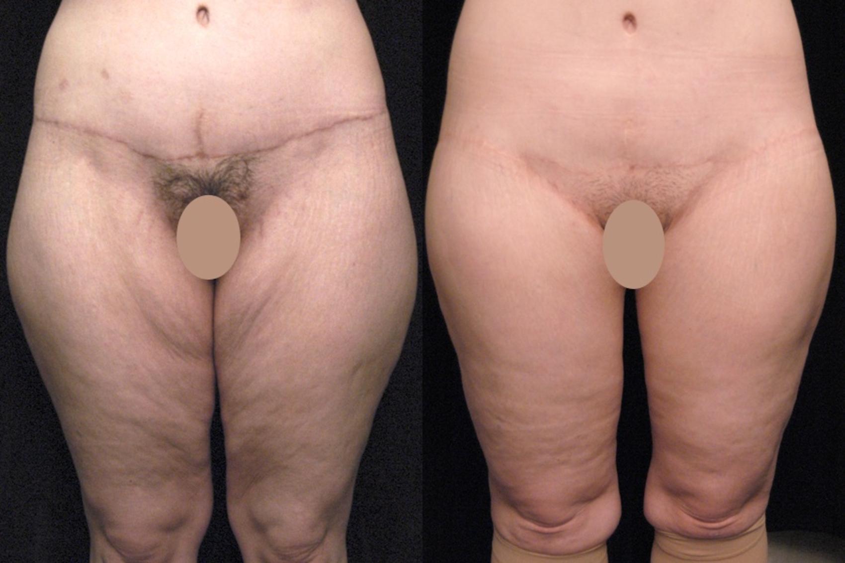 Before & After Thigh Lift Case 120 View #1 View in New York, NY