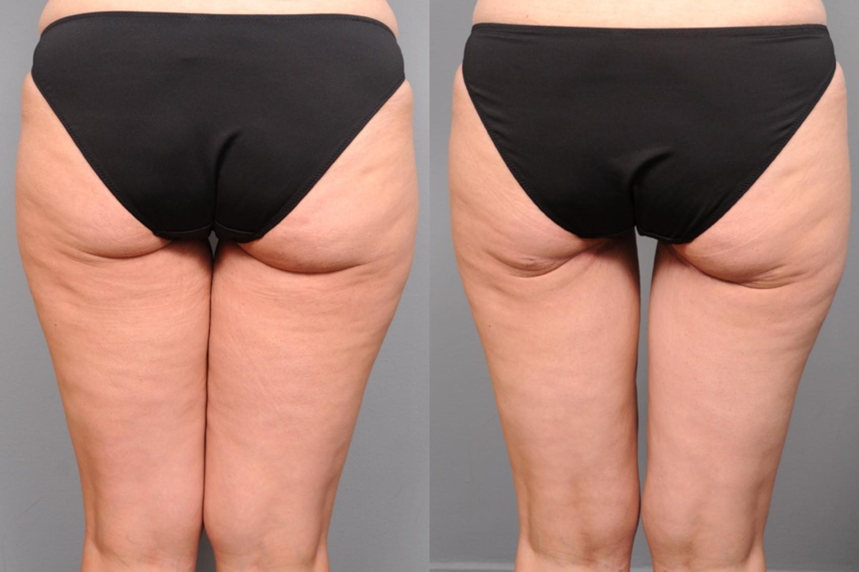 Before & After Thigh Lift Case 121 View #2 View in New York, NY