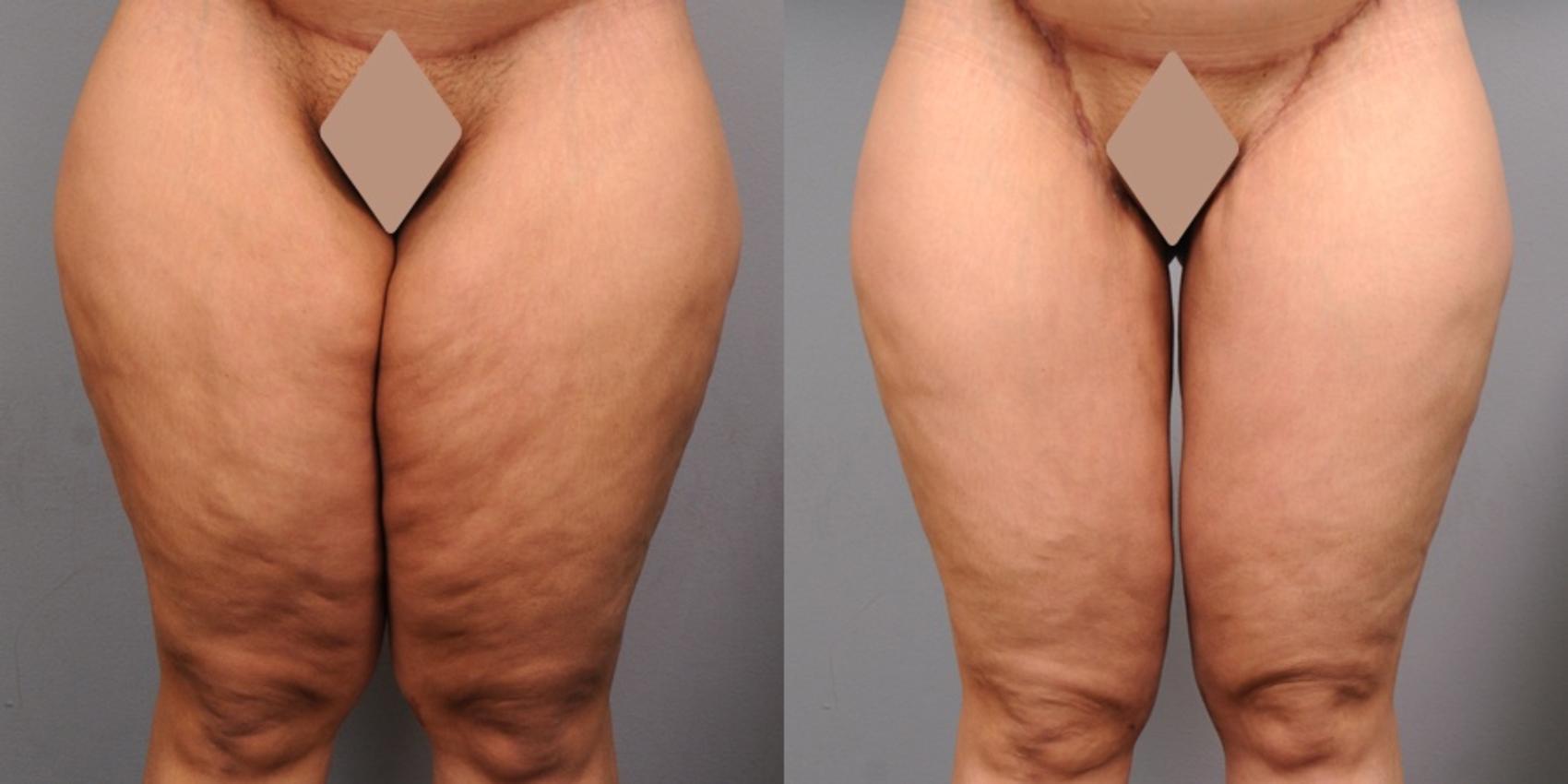 Before & After Thigh Lift Case 122 View #1 View in New York, NY