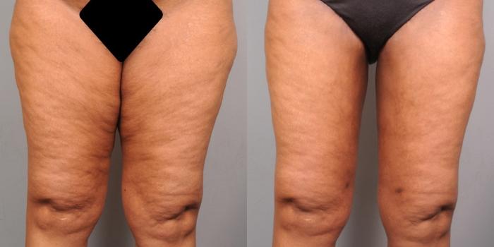 Before & After Thigh Lift Case 123 View #1 View in New York, NY