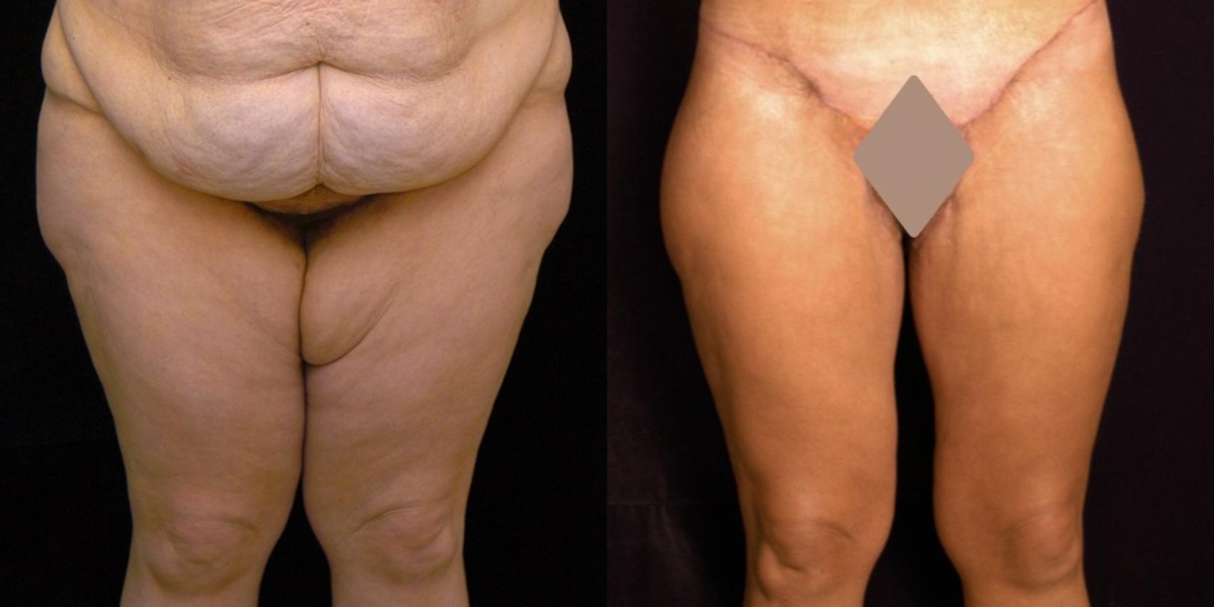 Before & After Thigh Lift Case 124 View #1 View in New York, NY