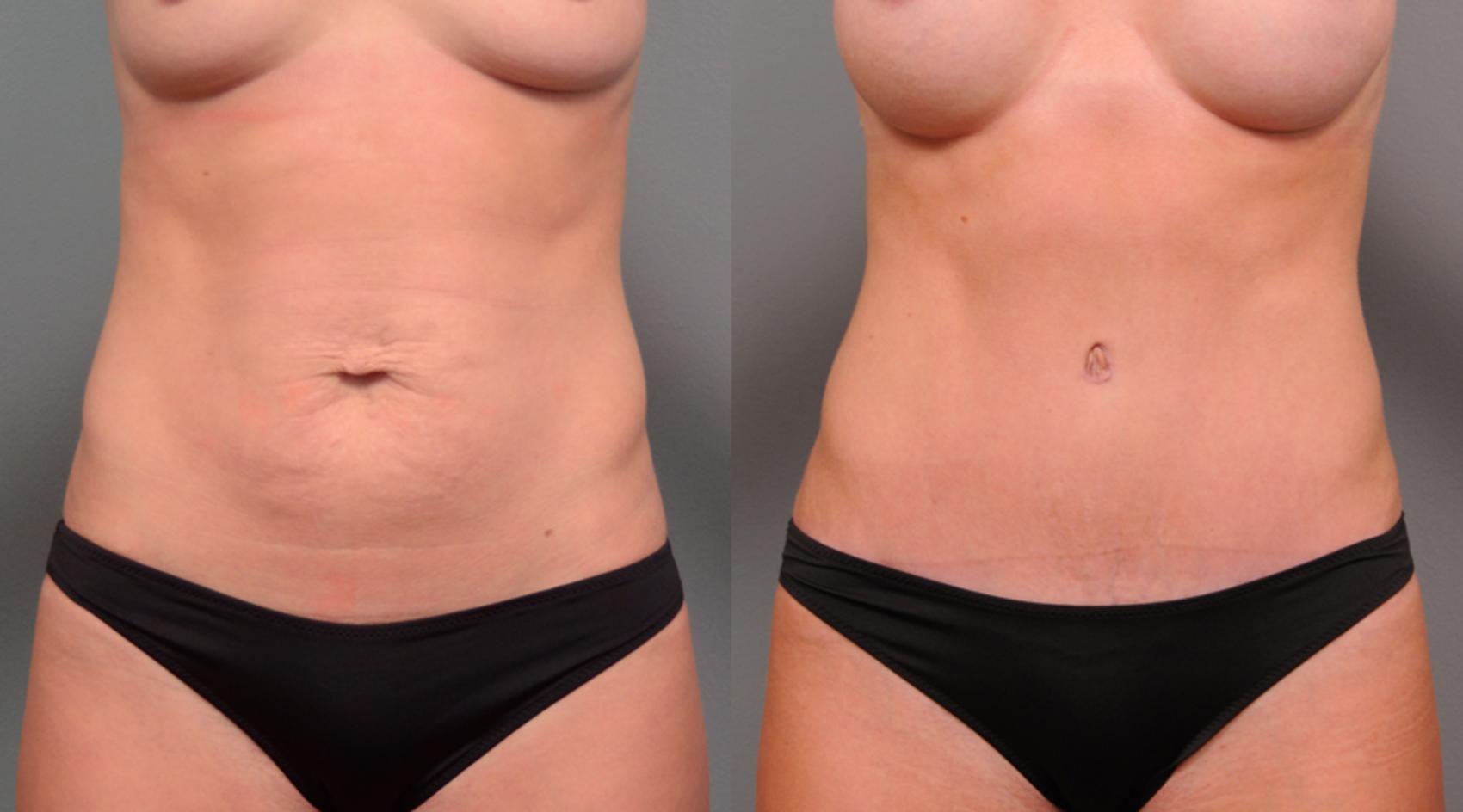 Before & After Tummy Tuck Case 156 View #1 View in New York, NY