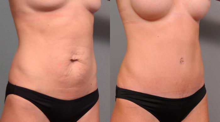 Before & After Tummy Tuck Case 156 View #2 View in New York, NY